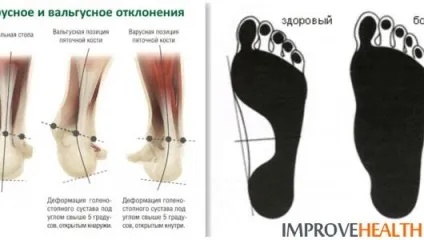 Види плоскостопості і як боротися з плоскостопістю (плоскостопості) Види плоскостопості і як боротися з плоскостопістю