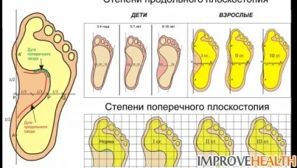 Види плоскостопості і як боротися з плоскостопістю (плоскостопістю) Види плоскостопості і як боротися з плоскостопістю