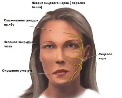 Запалення лицевого нерва симптоми і препарати для лікування в домашніх умовах (лицьового) Запалення лицевого нерва симптоми і препарати для лікування в домашніх умовах