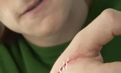 Хірургічні перев'язки швів після операції основні правила
