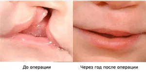 Заяча губа фото, причини, симптоми, лікування нестачі (причини) Заяча губа фото, причини, симптоми, лікування нестачі