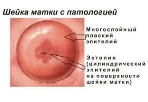 Залозиста псевдоерозія шийки матки симптоми і лікування (симптоми) Залозиста псевдоерозія шийки матки симптоми і лікування