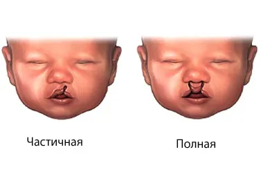 Заяча губа фото, причини, симптоми, лікування нестачі (губа) Заяча губа фото, причини, симптоми, лікування нестачі