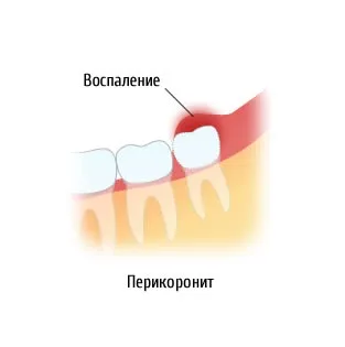 Зуб мудрості болить що робити (болить) Зуб мудрості болить що робити