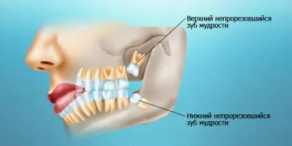 Зуб мудрості болить що робити (робити) Зуб мудрості болить що робити