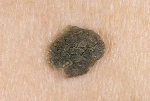 Кератоз лікування народними засобами (верхнього шару шкіри) Кератоз лікування народними засобами