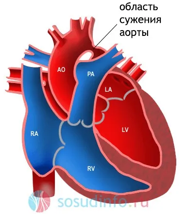 Коарктация аорти у новонароджених дітей операція, симптоми, лікування (аорти) Коарктация аорти у новонароджених дітей операція, симптоми, лікування