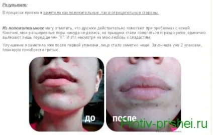 Коли пивні дріжджі допомагають від прищів краще засобів (допомагають) Коли пивні дріжджі допомагають від прищів краще засобів