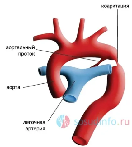 Коарктация аорти у новонароджених дітей операція, симптоми, лікування (дітей) Коарктация аорти у новонароджених дітей операція, симптоми, лікування