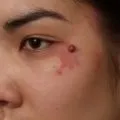 Коли з'являються перші родимки у дітей і чи можуть бути небезпечні (родимки) Коли з'являються перші родимки у дітей і чи можуть бути небезпечні