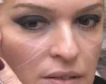 Корекція підборіддя філлерамі, гіалуронова кислота (підборіддя) Корекція підборіддя філлерамі, гіалуронова кислота