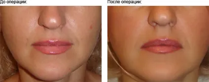 Контурна пластика обличчя - що це таке які препарати використовуються, ціна, рекомендації та відгуки (особи) Контурна пластика обличчя - що це таке які препарати використовуються, ціна, рекомендації та відгуки