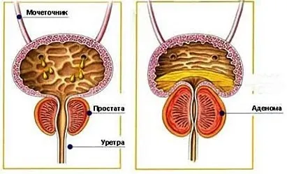 Аденома простати - клініка 29