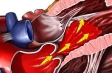 Лікування пороку серця народними засобами (лікування вади серця) Лікування пороку серця народними засобами