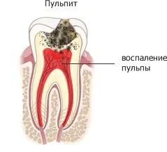 Лікування карієсу та його ускладнення - послуги - стоматологія для всієї родини (всієї) Лікування карієсу та його ускладнення - послуги - стоматологія для всієї родини