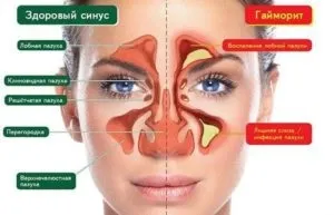 Лікування синуситу у дорослих препарати, таблетки, ліки (лікування) Лікування синуситу у дорослих препарати, таблетки, ліки