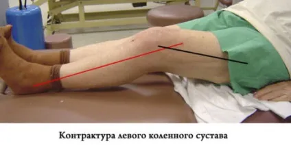 Лікування артрозу колінного суглоба народними засобами що, як і навіщо (артрозу) Лікування артрозу колінного суглоба народними засобами що, як і навіщо