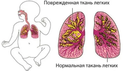 Лікування пневмонії у дітей народними засобами рецепт (рецепт) Лікування пневмонії у дітей народними засобами рецепт