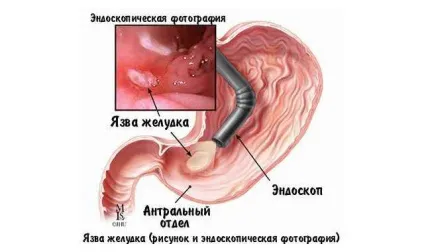 Лікування кишечника медом з прополісом при виразці шлунка (шлунка) Лікування кишечника медом з прополісом при виразці шлунка