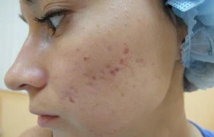 Лазерна наноперфорація особи що це, показання, протипоказання (косметологія хірургія пластика) Лазерна наноперфорація особи що це, показання, протипоказання