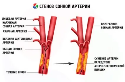 Лікування народними засобами стенозу перевірені рецепти (лікування) Лікування народними засобами стенозу перевірені рецепти
