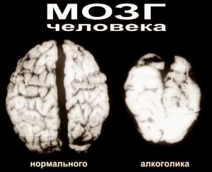 Алкогольна деменція (недоумство) симптоми, лікування і відновлення мозку і центральної нервової системи (захворювання алкогольна деменція) Алкогольна деменція (недоумство) симптоми, лікування і відновлення мозку і центральної нервової системи