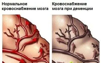 Алкогольна деменція, її симптоми і лікування (лікування) Алкогольна деменція, її симптоми і лікування