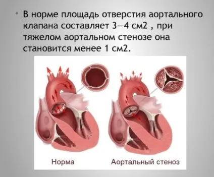 Аортальний стеноз (симптоми, діагностика, лікування) (лікування) Аортальний стеноз (симптоми, діагностика, лікування)