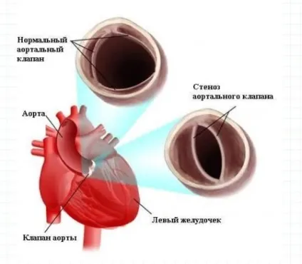 Аортальний стеноз (симптоми, діагностика, лікування) (аортальний) Аортальний стеноз (симптоми, діагностика, лікування)