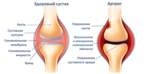 Артрит лікування захворювання засобами народної медицини, особливості лікування такими методами (лікування) Артрит лікування захворювання засобами народної медицини, особливості лікування такими методами