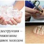 Бородавки на руках - причини і лікування в домашніх умовах (причини) Бородавки на руках - причини і лікування в домашніх умовах