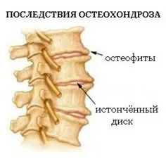 Біль в серці при остеохондрозі характерні симптоми (серце) Біль в серці при остеохондрозі характерні симптоми
