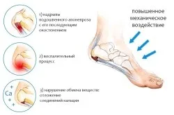 Болять стопи ніг і п'яти причини (болять) Болять стопи ніг і п'яти причини