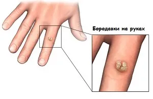 Бородавки на руках - причини і лікування в домашніх умовах (бородавки) Бородавки на руках - причини і лікування в домашніх умовах