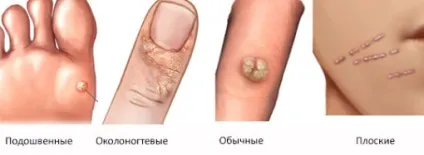 Бородавки на руках - причини і лікування в домашніх умовах (лікування) Бородавки на руках - причини і лікування в домашніх умовах