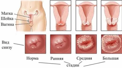 Велика ерозія шийки матки (ерозія) Велика ерозія шийки матки