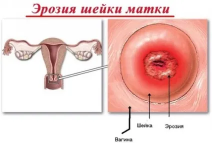 Велика ерозія шийки матки (слизової шийки матки) Велика ерозія шийки матки