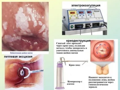 Велика ерозія шийки матки (матці локалізована шийці) Велика ерозія шийки матки