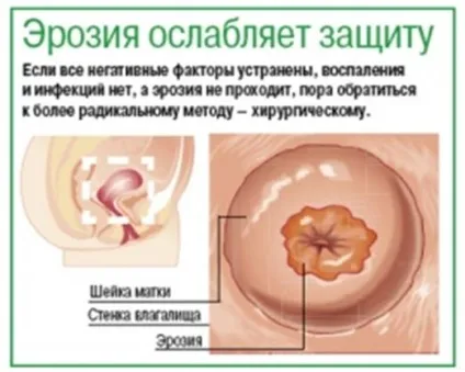 Велика ерозія шийки матки (велика) Велика ерозія шийки матки