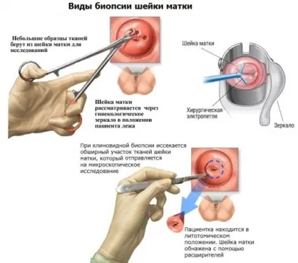 Велика ерозія шийки матки (ерозія) Велика ерозія шийки матки