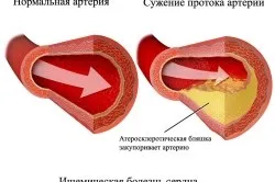 Чим небезпечна ішемія серця