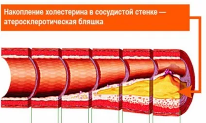 Чим небезпечний атеросклероз судин головного мозку (атеросклероз) Чим небезпечний атеросклероз судин головного мозку
