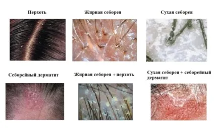 Чим для людини шкідлива лупа (волосся позбавлення лупи) Чим для людини шкідлива лупа