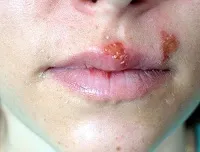 Що буде якщо здерти герпес, що робити, якщо здерла (герпес) Що буде якщо здерти герпес, що робити, якщо здерла