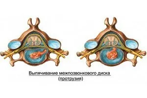 Чим протрузія відрізняється від грижі міжхребцевих дисків (дисків) Чим протрузія відрізняється від грижі міжхребцевих дисків