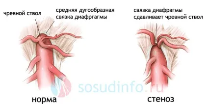 Черевний стовбур стеноз, компресія, анатомія