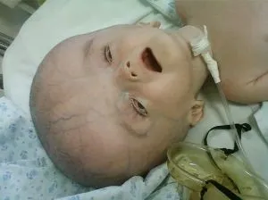 Що таке поренцефалія головного мозку лікування, прогноз, клініка