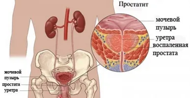 Що таке лод терапія, наскільки вона ефективна при простатиті (терапія) Що таке лод терапія, наскільки вона ефективна при простатиті
