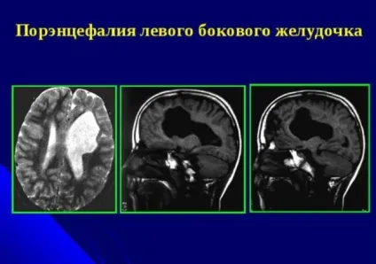 Що таке поренцефалія головного мозку лікування, прогноз, клініка