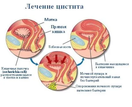 Цистит часте і хворобливе сечовипускання (хворобливе) Цистит часте і хворобливе сечовипускання